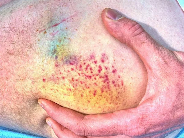 Grande Hematoma Colorido Corpo Humano Sofrimento Doloroso Após Incidente Desportivo — Fotografia de Stock