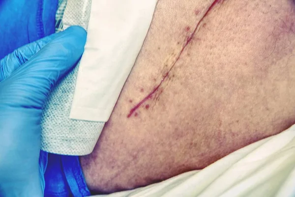 Paciente Con Una Cicatriz Larga Fresca Después Una Cirugía Cadera — Foto de Stock