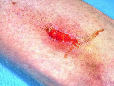 El kucaklayan bacak acı yer ile yaralandı. Doktor eli kanlı alan şifa. Taze aşınma. Deride derin yara.