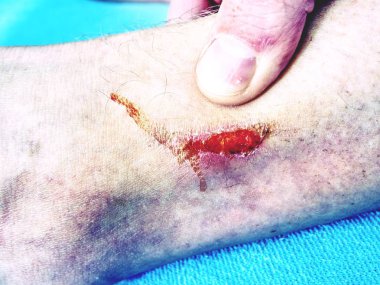 El kucaklayan bacak acı yer ile yaralandı. Doktor eli kanlı alan şifa. Taze aşınma. Deride derin yara.