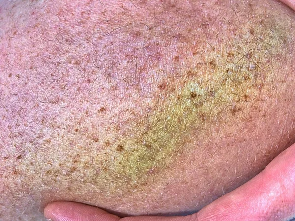 Purple Bruise Affected Skin Close View Colorful Hematoma Large Bruises — Stock Photo, Image