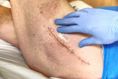 Taze bir uzun yara izi bir kalça ameliyat sonrası hastada. Makro, insan bacak kalça eklemi cerrahisi kanlı yara izi ile.