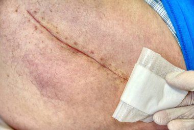 Harap kalça eklem kalça endoprotezde için değiştirme. Taze yara izi ile insan bacak seçici odak.