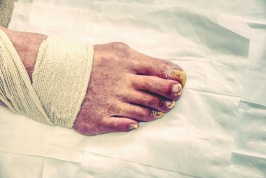 Pedikür aşamaları. Podology, kesme derileri. Profesyonel pedikür hastanede. Çivi kırpma ayaklarına.