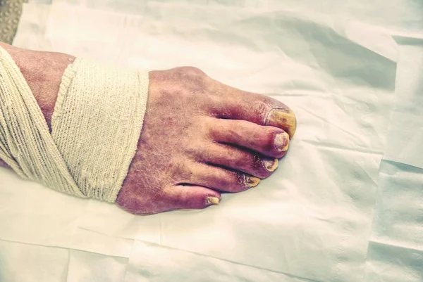 Pedikür aşamaları. Podology, kesme derileri. Profesyonel pedikür hastanede. Çivi kırpma ayaklarına.