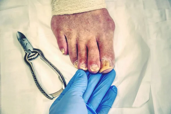 Manicurista Ospedaliero Con Pinze Pedicure Che Tagliano Unghia Del Piede — Foto Stock