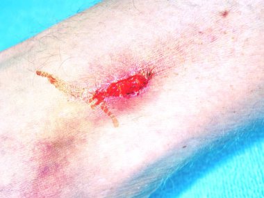 Doktorlar bir yanmış cilt alan şifa ver. El kucaklayan yer ile acı aşınma çizikler kazasından yaralı.