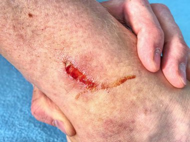 El kucaklayan bacak acı yer ile yaralandı. Doktor eli kanlı alan şifa. Taze aşınma. Deride derin yara.