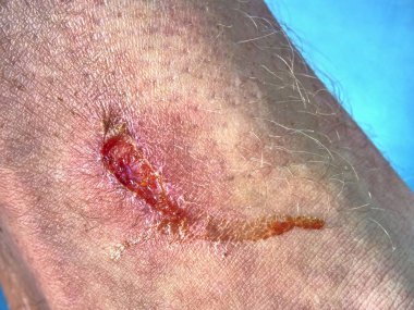 Taze etkilenen kanlı deri. Çürükler ve ıslak parçaları ile deride derin çizikler