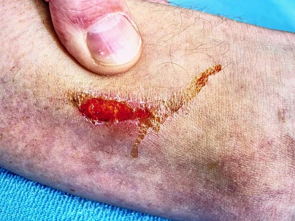 Скорая Помощь Кровавой Ране Ноги Красной Зоной Воспаления Спортивная Травма — стоковое фото