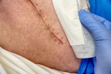 Harap kalça eklem kalça endoprotezde için değiştirme. Taze yara izi ile insan bacak seçici odak.