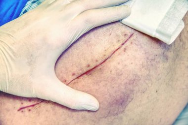 Seçici odak eski erkek insan bacak yara izi ile. Hasta bir kalça eklemi cerrahisi sonrası uzun bir yara izi ile.