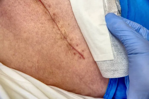 Harap kalça eklem kalça endoprotezde için değiştirme. Taze yara izi ile insan bacak seçici odak.