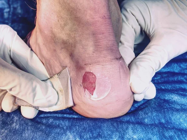 Yaralı bacak üzerinde blister üzerinde yara bandı. Pelet topuk ile blister alçı, acı yer