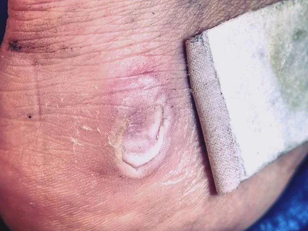 Yaralı bacak üzerinde blister üzerinde yara bandı. Pelet topuk ile blister alçı, acı yer