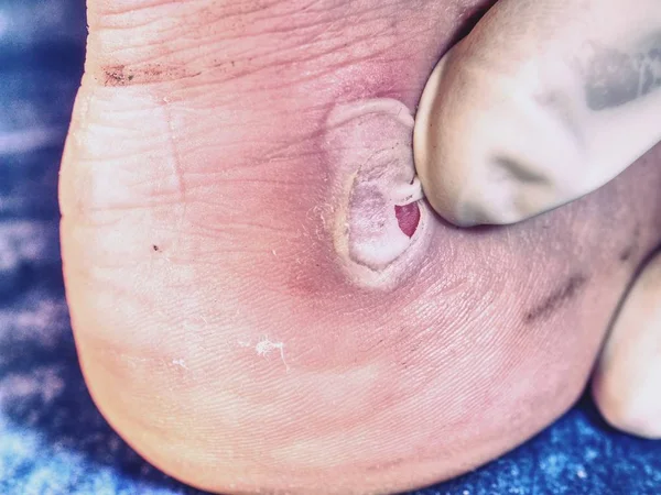 Kurutma ve temizlik topuk üzerinde kanlı blister kırık. Çok acı verici bir yer. Kötü cilt ile ayak topuk çatlakları ile kaplıdır