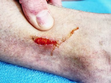 Doktorlar bir yanmış cilt alan şifa ver. El kucaklayan yer ile acı aşınma çizikler kazasından yaralı.