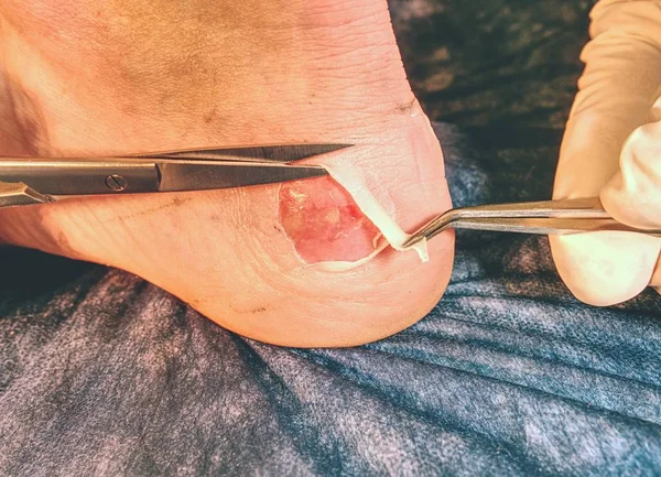 Doktor ölü deri bacak kesme. Craced korkunç blister insan topuk üzerinde. Adam ayak kanlı acı cilt ıslak 