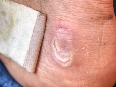Adam ayak yapıştırıcı sıva ile kanlı acı cilt ıslak. Bandaj ile yara blister yakın Aşil topuğu, yara bandı, yakın çekim