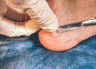 Cerrah hastaların steril makasla ölü deri keser. Topuk korkunç aşındırıcı yer ile zarar temizliği ve ıslak blister kırık