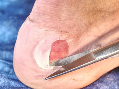 Doktor ölü deri bacak kesme. Craced korkunç blister insan topuk üzerinde. Adam ayak kanlı acı cilt ıslak 