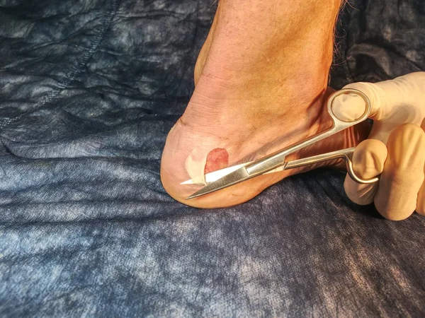 Νοσοκόμα Καθαρισμού Νεκρό Δέρμα Στο Πόδι Ασθενούς Ακίδα Ψαλίδι Μπλε — Φωτογραφία Αρχείου