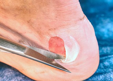 Harap Cilt Doktor eller tarafından Temizleme detay. Profesyonel yardım hastanede. Çürükler ve ıslak parçaları ile deride derin çizikler
