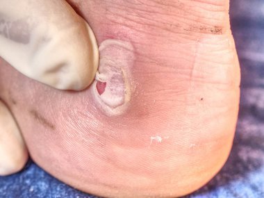 Büyük acı ve kanlı blister Pelet topuk üzerinde. Adam ayak ciltte ıslak kırık Kallus 