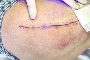 Eski insan bacak kalça eklemi cerrahisi ameliyat sonrası yara izi ile. Detay deri derin chirurgical ile kesti. Hastanede sağlık. Hipster filtre. 