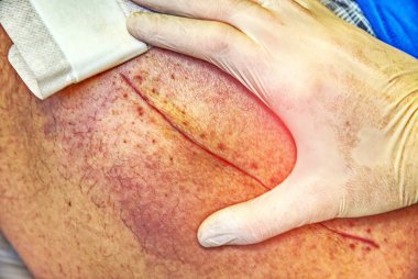 Eski insan bacak kalça eklemi cerrahisi ameliyat sonrası yara izi ile. Detay deri derin chirurgical ile kesti. Hastanede sağlık. Hipster filtre. 