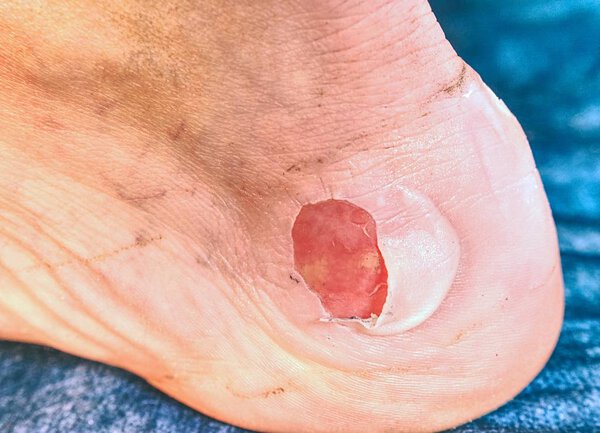 Жуткая рана. Удаление обожженной кожи с прикрепленного места в Ахиллесовом сухожилии
. 