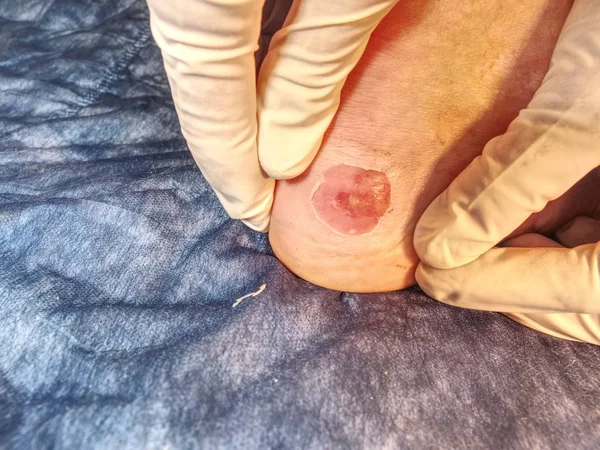 Небольшая Операция Больной Ноге Лечение Мокрой Раны Неприкасаемая Горячая Пятка — стоковое фото