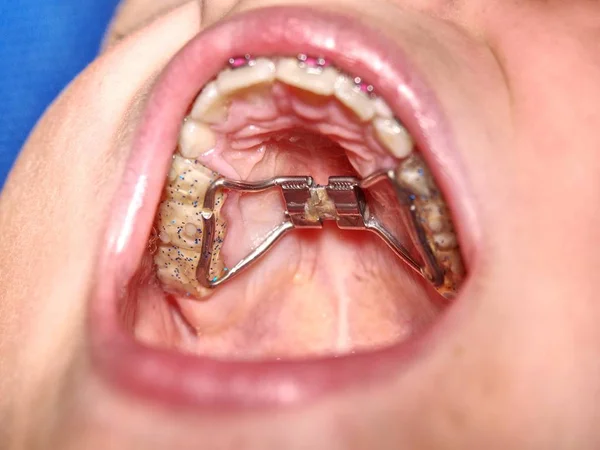 Οδοντική Τιράντες Στο Στόμα Ένα Νεαρό Αγόρι Έφηβος Σιδεράκια Στα — Φωτογραφία Αρχείου