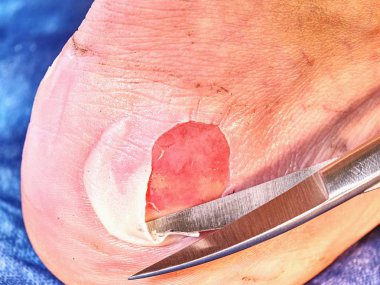 Spike makas, mavi steril arka plan ile hasta bacakta temizlik ölü deri hemşire. Çürükler ve ıslak parçaları ile deride derin çizikler