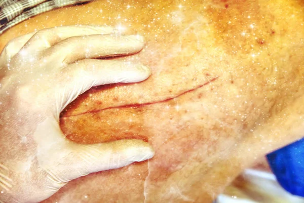 Paciente Mês Após Cirurgia Cicatriz Longa Anca Controle Cicatrização Limpar — Fotografia de Stock