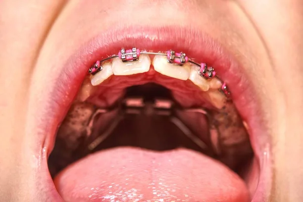 Aparelhos Dentários Boca Rapaz Adolescente Com Aparelho Nos Dentes Ortodontia — Fotografia de Stock