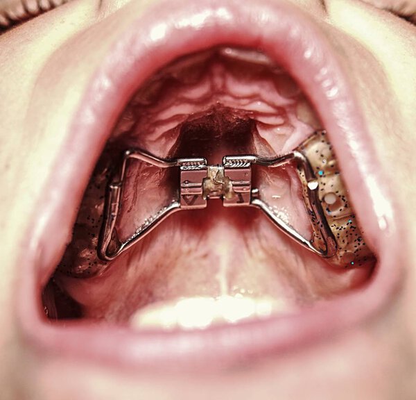 Kid wearing orthodontic palatal expanding trainer. Invisible braces aligner. Popular orthodontic appliance for birth dental deffect