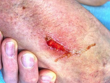 Doktorlar bir yanmış cilt alan şifa ver. El kucaklayan yer ile acı aşınma çizikler kazasından yaralı.