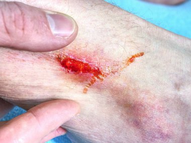 El kucaklayan bacak acı yer ile yaralandı. Doktor eli kanlı alan şifa. Taze aşınma. Deride derin yara.