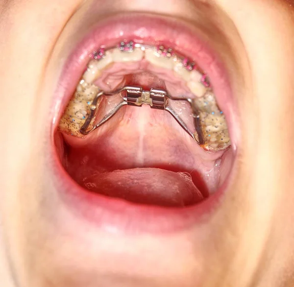 Ασθενής Υπερώας Πλαίσιο Επάνω Δόντια Πρωτογενή Νεογιλά Δόντια Μωρού Παιδιού — Φωτογραφία Αρχείου