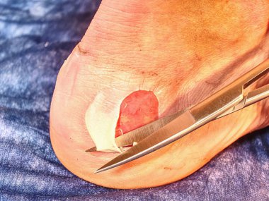 Yanlış botlar ve hastalar ayak deride yara enfeksiyonu blister. 