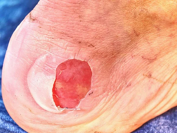 Небольшая Операция Больной Ноге Лечение Мокрой Раны Неприкасаемая Горячая Пятка — стоковое фото