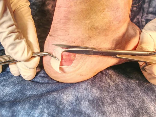 Surgeon cuts the patients dead skin with sterile scissors. Cleaning of hurt heel with horrible abrasive place and cracked wet blister