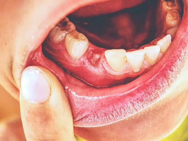 Child showing the first canine tooth pulled out. Boy mouth of toddler without canine milky tooth. Toothless boy mouth