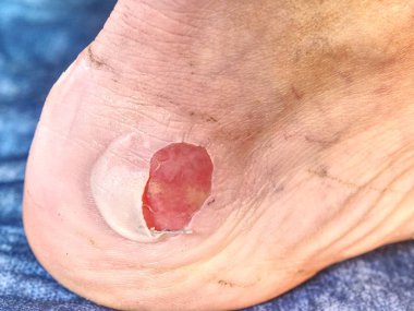 Spor kazadan sonra bacak üzerinde taze kanlı blister detayını. Erkek deri sıcak ve dokunulmaz bir yer. 