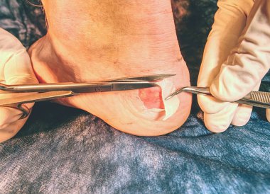 Spike makas, mavi steril arka plan ile hasta bacakta temizlik ölü deri hemşire. Çürükler ve ıslak parçaları ile deride derin çizikler