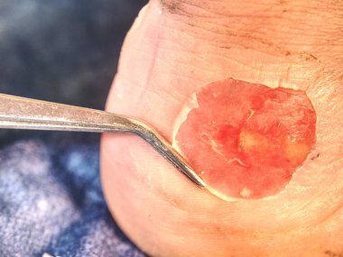 Yanlış botlar ve hastalar ayak deride yara enfeksiyonu blister. 