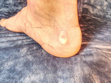 Büyük acı ve kanlı blister Pelet topuk üzerinde. Adam ayak ciltte ıslak kırık Kallus 