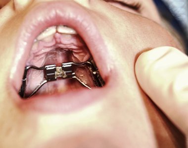 Yaban faresi hızlı palatal genişleme parantez ince çene düzeltme için. Çocuk gösterileri kare ayraçlar diş. 