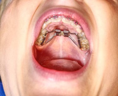 Yaban faresi hızlı palatal genişleme parantez ince çene düzeltme için. Çocuk gösterileri kare ayraçlar diş. 